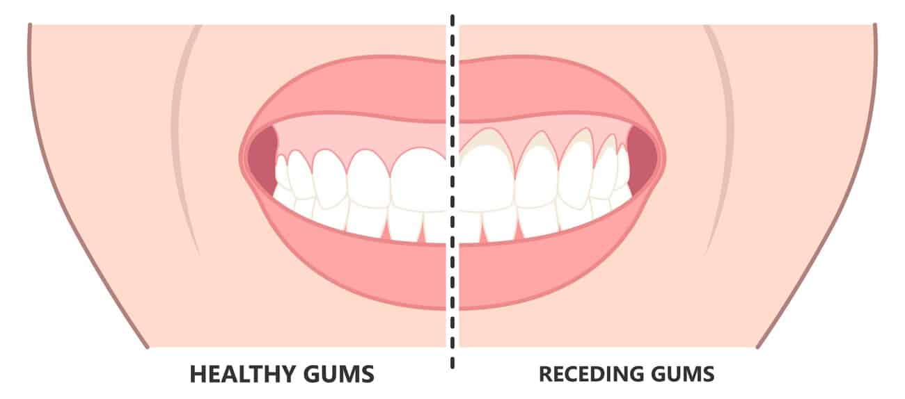 What Causes Gums to Recede Over Time Loughton